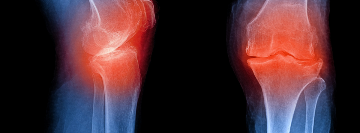 Does Collagen Really Help Arthritis | Vitality and Wellness Centre