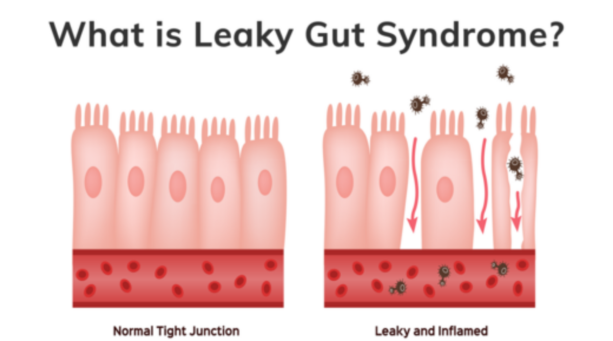 What Is Leaky Gut Syndrome Podcast | Vitality and Wellness Centre